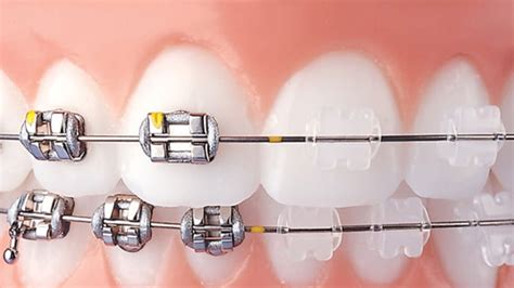 diferencia entre brackets metalicos y ceramicos|Brackets de cerámica vs. brackets metálicos  .